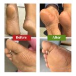 Vilvah Foot Cream for Cracked Heels | Repairs Dry, Rough & Damaged Feet | Softens Calluses & Removes Dead Skin | Deep Hydration & Odour Control | 100ml - Image 8